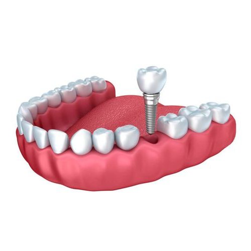 Implantologia Dentale - Singolo Impianto
